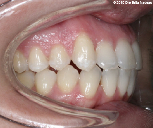 Marie-Hélène Cyr - Right lateral intraoral view - After orthodontic treatments and orthognathic surgeries (January 29, 2010)